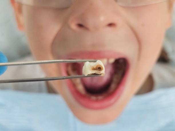 Best Emergency Wisdom Teeth Removal in Chattahoochee, FL
