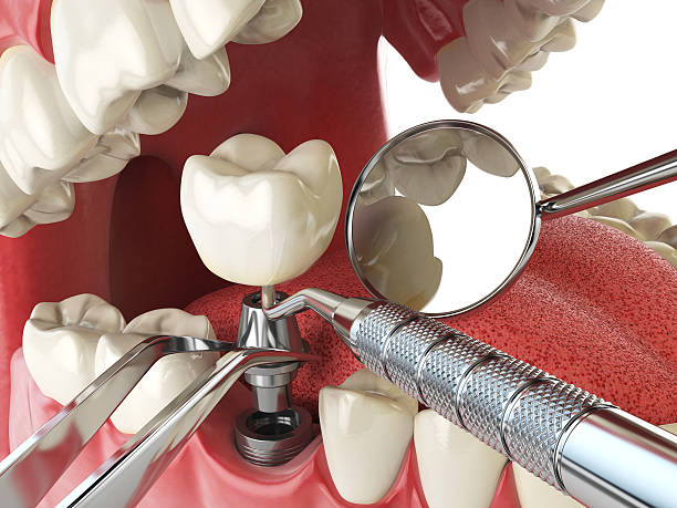 Best Urgent Care for Lost Fillings or Crowns in Chattahoochee, FL